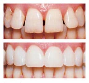 Rebuild Your Smile With Veneers